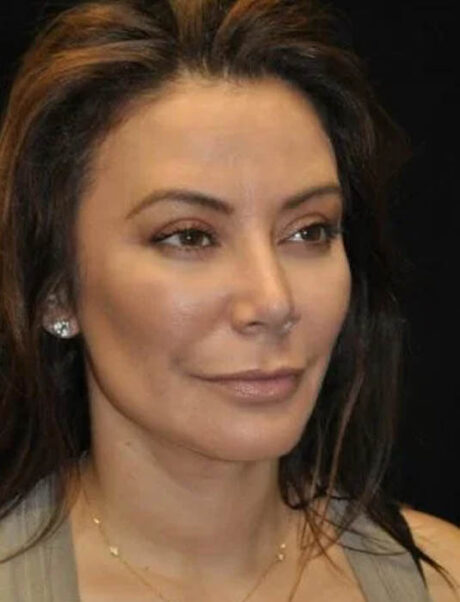 Facial Fat Grafting case #4605