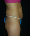 Liposuction case #4778