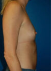 Breast Augmentation case #3739