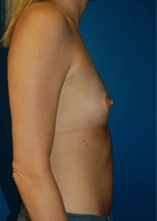 Breast Augmentation case #3739