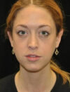Facial Fat Grafting case #4610