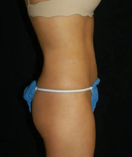 Liposuction case #4778