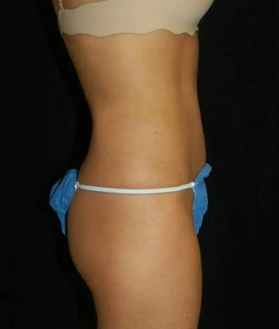 Liposuction case #4778