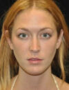 Facial Fat Grafting case #4610