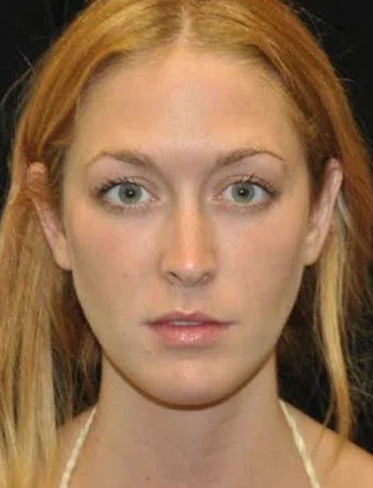 Facial Fat Grafting case #4610