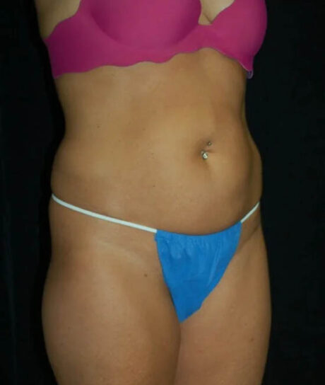 Liposuction case #4778