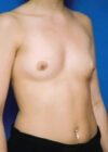 Breast Augmentation case #3744
