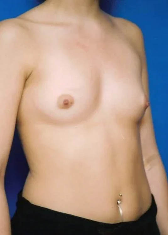 Breast Augmentation case #3744