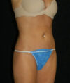 Liposuction case #4778