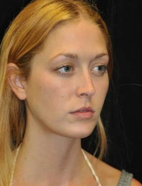 Facial Fat Grafting case #4610