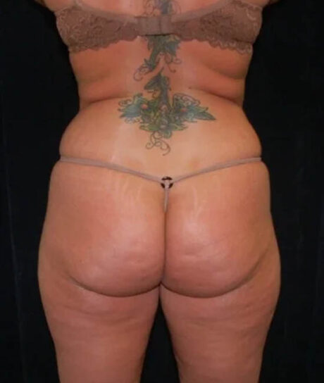 Liposuction case #4785