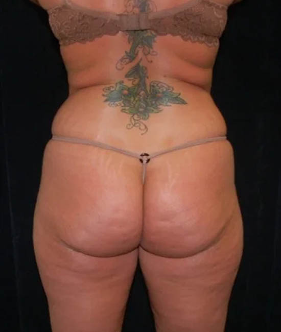 Liposuction case #4785