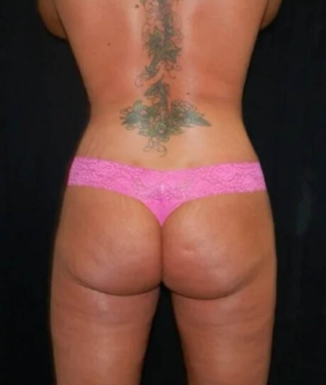 Liposuction case #4785