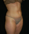 Liposuction case #4785