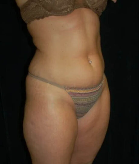 Liposuction case #4785