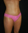Liposuction case #4785