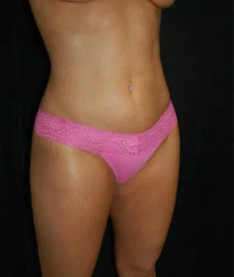 Liposuction case #4785