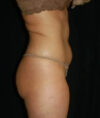 Liposuction case #4785