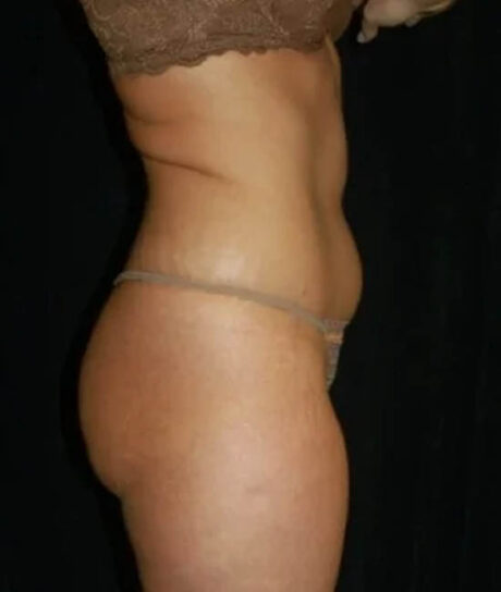 Liposuction case #4785