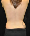 Liposuction case #4792