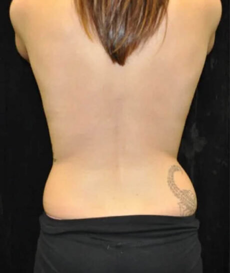 Liposuction case #4792