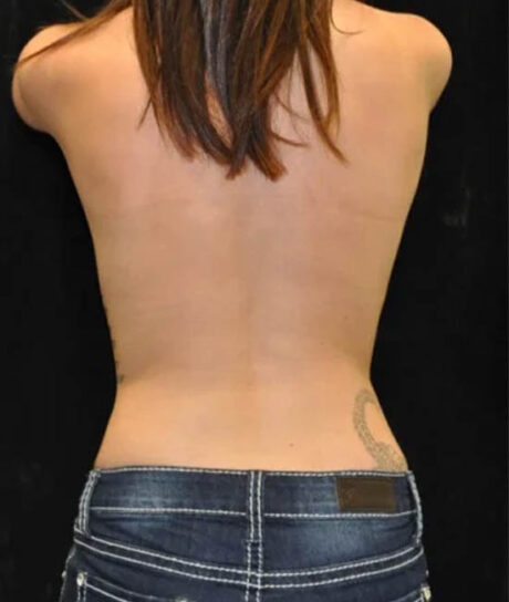 Liposuction case #4792