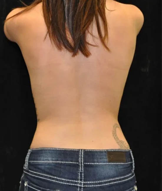 _0111_case-19-1-liposuction-view-1-2.webp