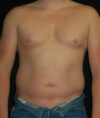 Liposuction case #4797