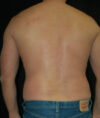 Liposuction case #4797