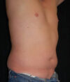 Liposuction case #4797
