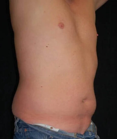 Liposuction case #4797