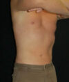 Liposuction case #4797