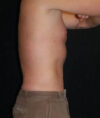 Liposuction case #4797