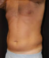 Liposuction case #4806