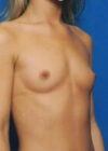 Breast Augmentation case #3774