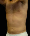 Liposuction case #4806