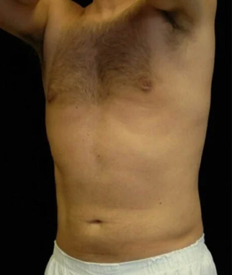 Liposuction case #4806