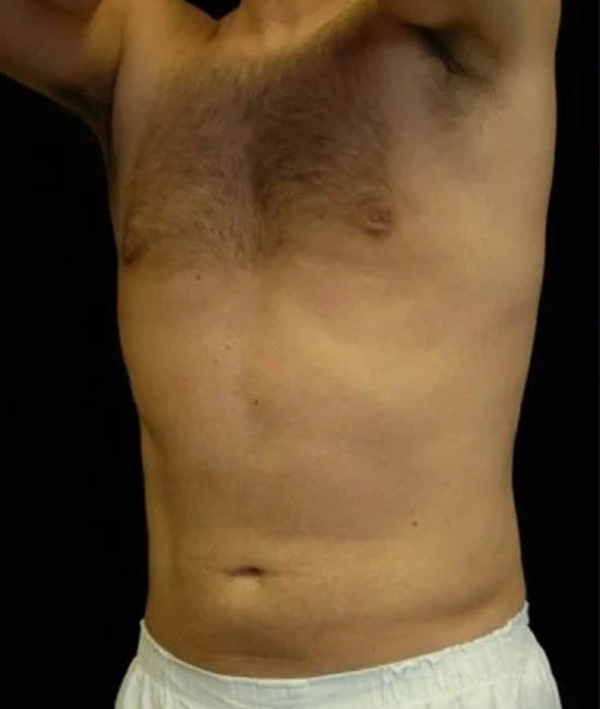 _0123_case-20-2-liposuction-view-1-2.webp