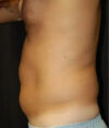Liposuction case #4806