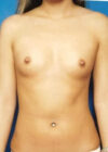 Breast Augmentation case #3777