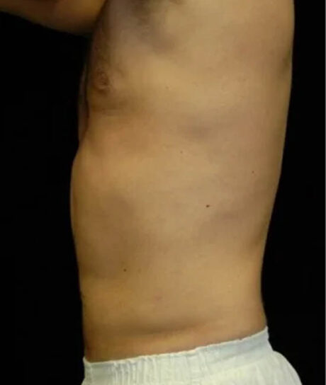 Liposuction case #4806