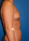 Breast Augmentation case #3764