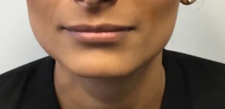 Dermal Fillers case #4366