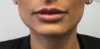 Dermal Fillers case #4366