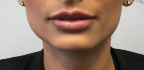 Dermal Fillers case #4366