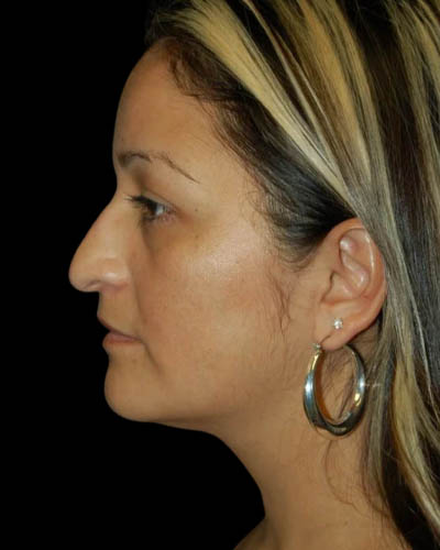 Facial Fat Grafting case #4527