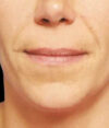 Lip Lift case #4661
