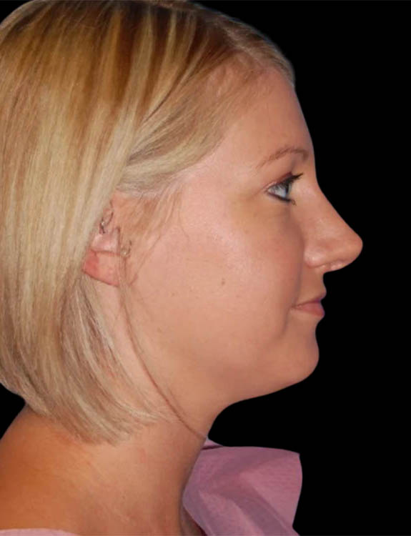 Neck Liposuction case #4970