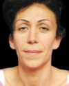 Blepharoplasty case #3487