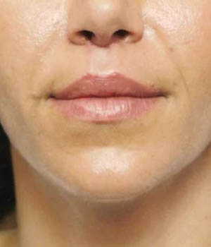 Lip Lift case #4661